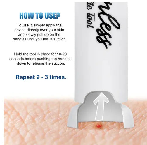 Itch Relief Suction Tool for Bug Bites Bright Supplies